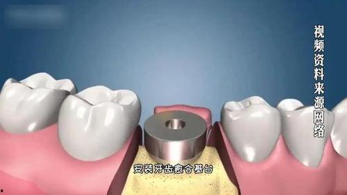 怎么种植牙视频全过程,从术前准备到术后护理