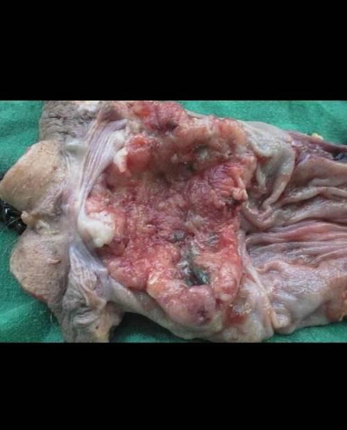 医院直肠滴灌视频,直肠滴灌操作步骤及注意事项解析